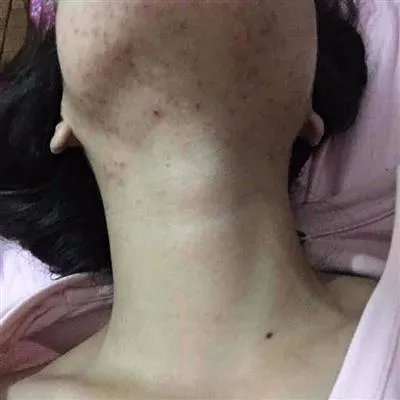 脸上有痘印怎么办呢