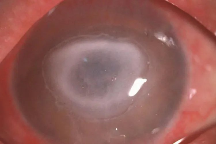 角膜炎初期症状图片