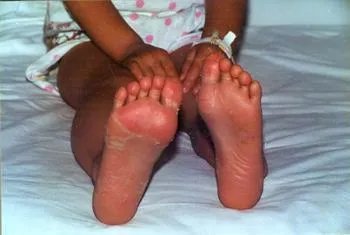 如何看待英国多个重症监护病房儿童身上出现罕见病，是新冠出现变异了么？