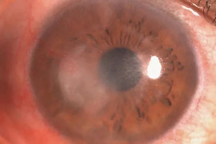 角膜炎初期症状图片