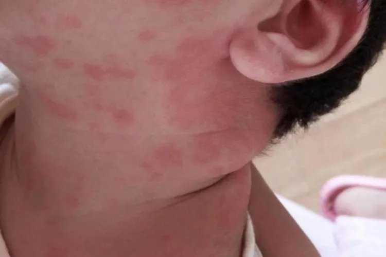 小孩过敏症状图片
