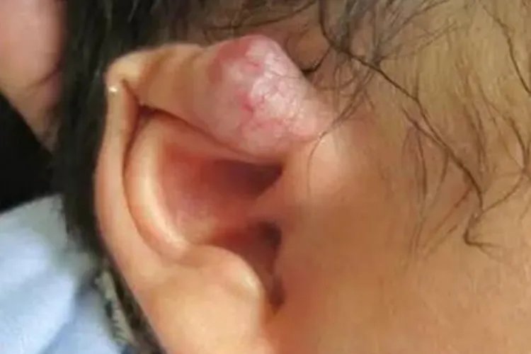 耳朵血管瘤图片