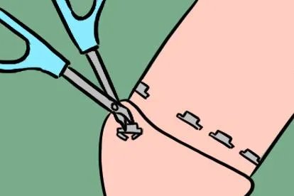 钛钉自取方法及图片