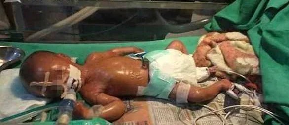 塑料婴儿的病症有哪些？