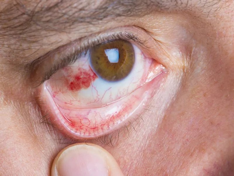 眼睛结膜出血怎么解决