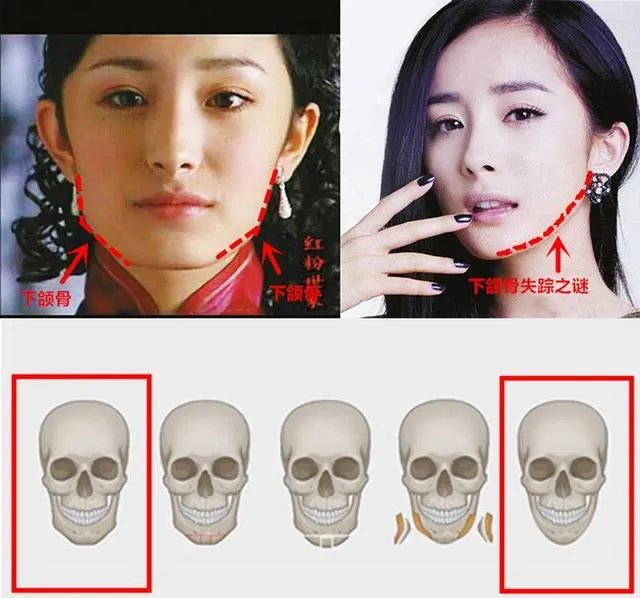 拔智齿真的可以瘦脸吗？有何依据？