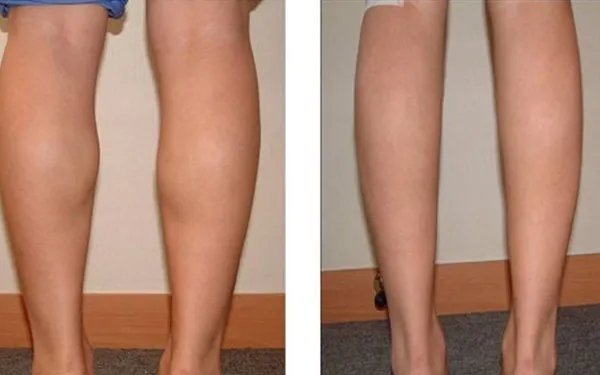 减小腿最有效的方法