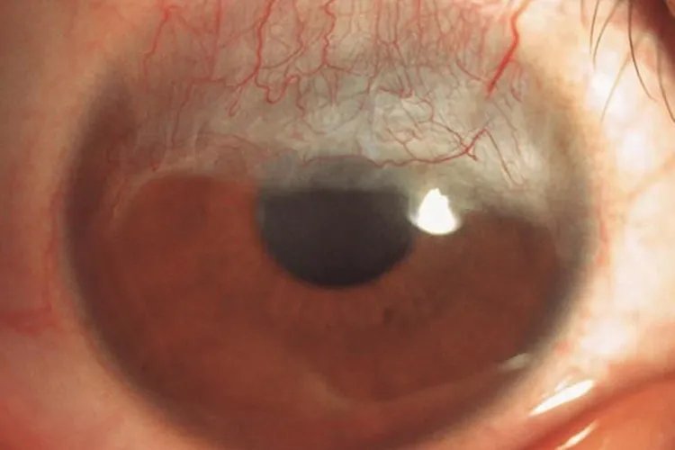 角膜炎初期症状图片