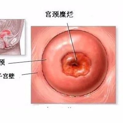 轻度宫颈糜烂的治疗