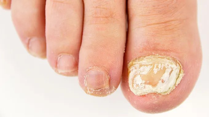 灰指甲治疗方法