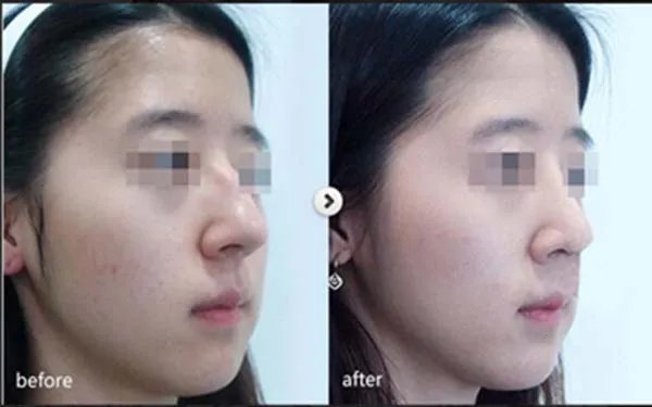 天津硅胶隆鼻口碑好的医院是哪家