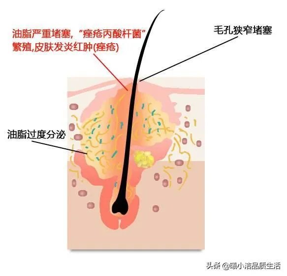 有没有真的适合痘痘肌的平价护肤品？