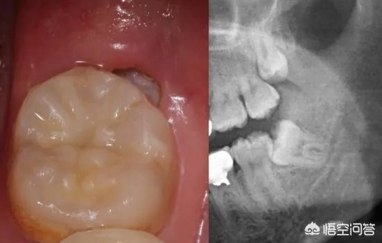 拔智齿真的可以瘦脸吗？有何依据？
