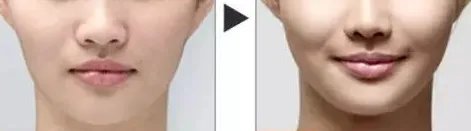 千万不要做自体脂肪填充全脸