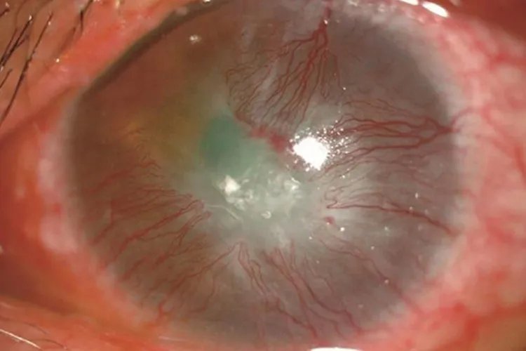 角膜炎初期症状图片