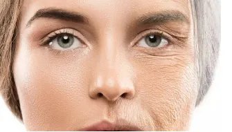 眼睛有皱纹怎么办