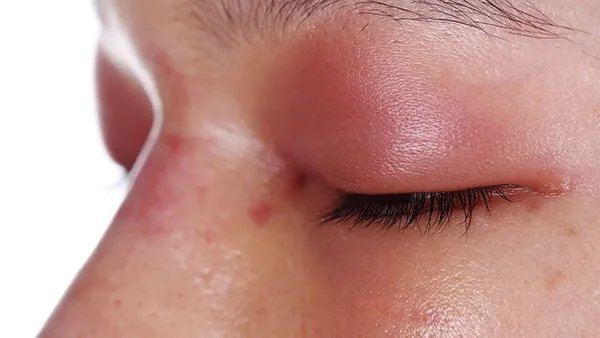 注射隆鼻整形容手术容易吗？