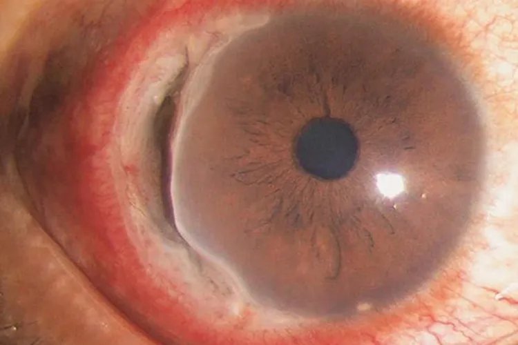 角膜炎初期症状图片