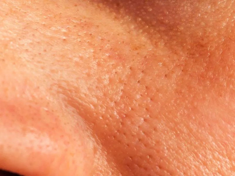 脸上的毛孔粗怎么办