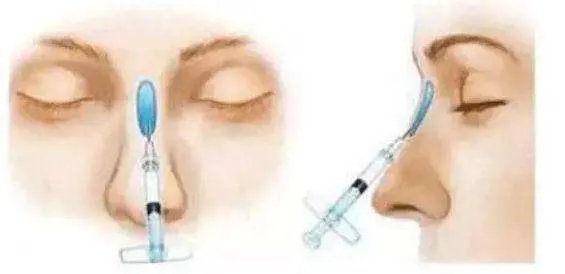 自体软骨隆鼻好不好