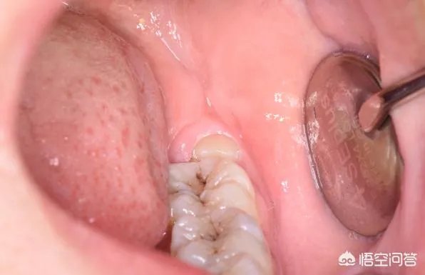 拔智齿真的可以瘦脸吗？有何依据？