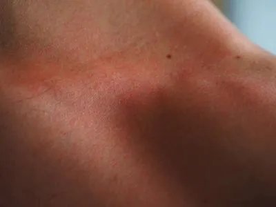 到了冬天皮肤痒是什么原因