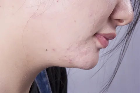 如何治脸上的痘坑