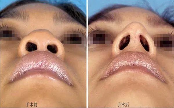 天津硅胶隆鼻口碑好的医院是哪家