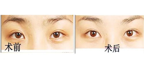 眼部抽脂术价格是多少
