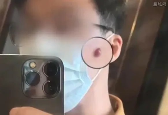男子反复挤痘出血不止引发血管瘤 要进行手术治疗
