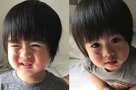 林志颖儿子跌伤脸 让粉丝大呼心疼