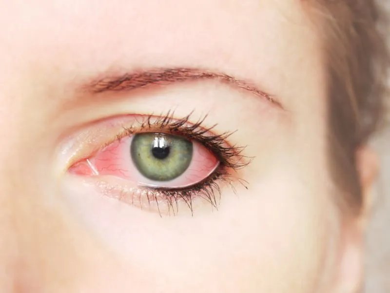 应该如何去红血丝