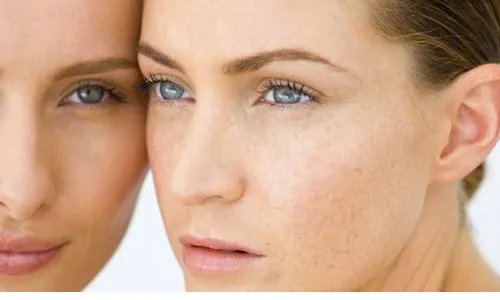 纯天然祛斑方法