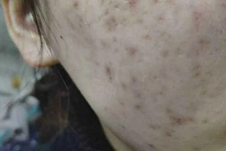 痘坑和痘印的区别图