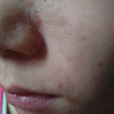 医院治疗痤疮怎么样