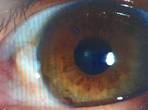 眼内隆起斑块可能是睑裂斑