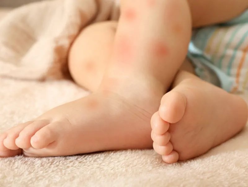 小儿湿疹的症状