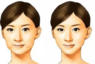 千万不要做自体脂肪填充全脸