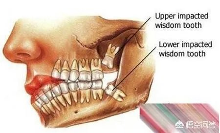 拔智齿真的可以瘦脸吗？有何依据？