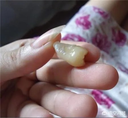 拔智齿真的可以瘦脸吗？有何依据？