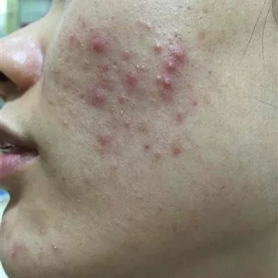 医院治疗痤疮怎么样