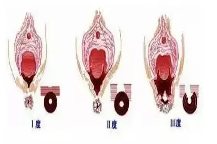 顺产3度撕裂肛门直肠图