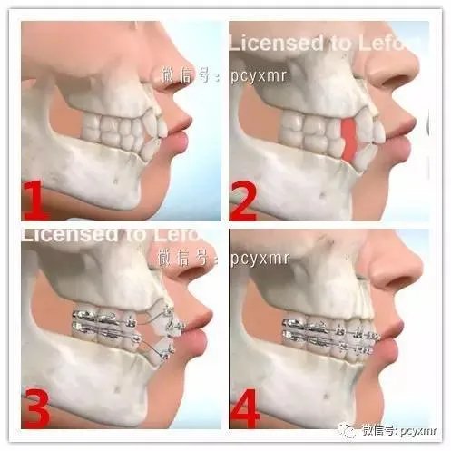 拔智齿真的可以瘦脸吗？有何依据？