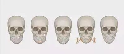 拔智齿真的可以瘦脸吗？有何依据？