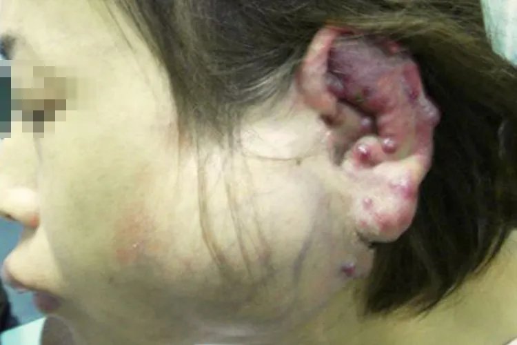 耳朵血管瘤图片