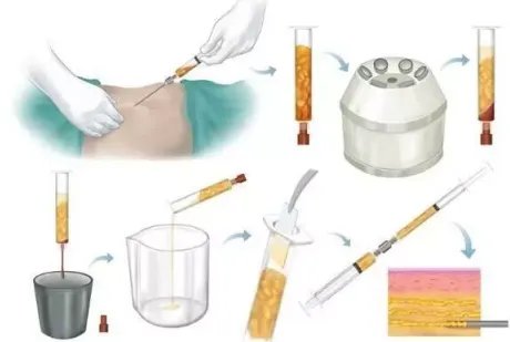 千万不要做自体脂肪填充全脸