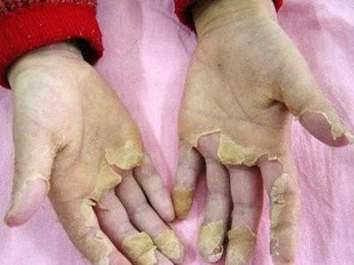 如何看待英国多个重症监护病房儿童身上出现罕见病，是新冠出现变异了么？