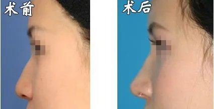 玻尿酸隆鼻的价格多少钱