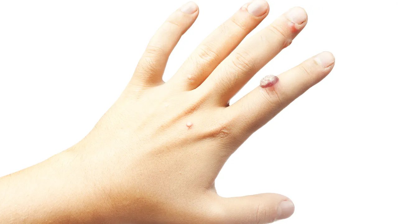 液氮治疗疣的效果