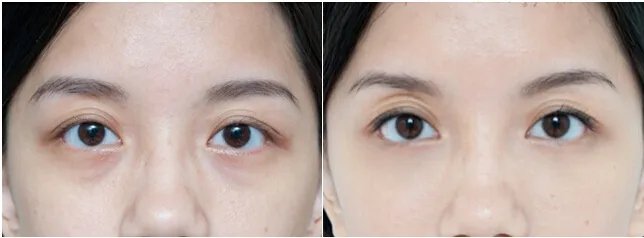 去眼袋的费用是多少